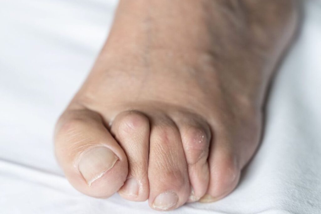 Comment corriger les orteils en marteau sans chirurgie ?