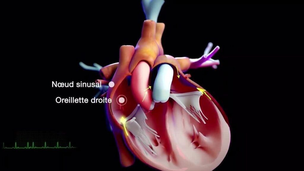 Fibrillations atriales : comment les reconnaître et les traiter ?