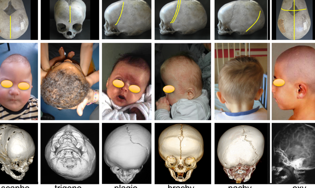Céphalhématome chez le nouveau-né : causes, symptômes et traitements