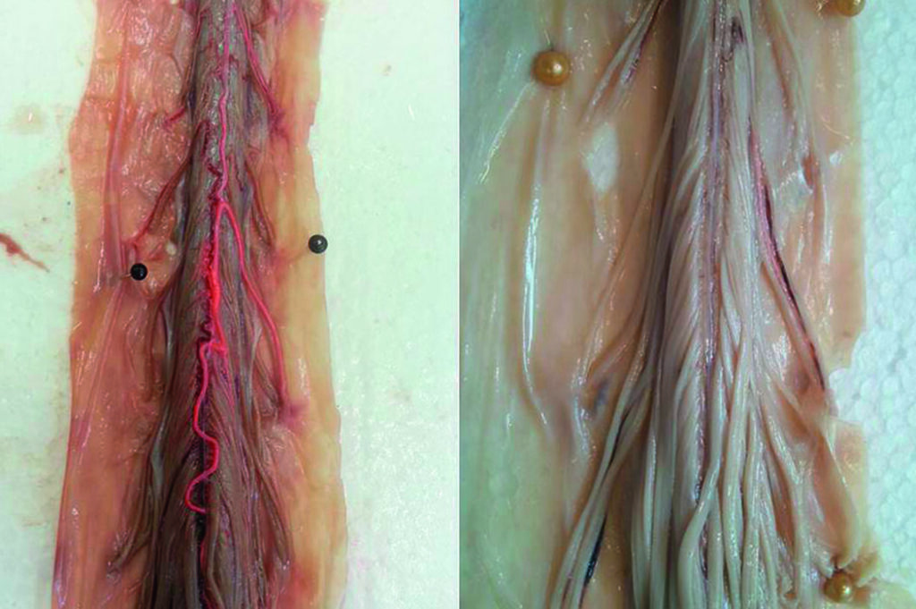 Dysraphismes spinaux : comprendre les causes, les symptômes et les traitements disponibles