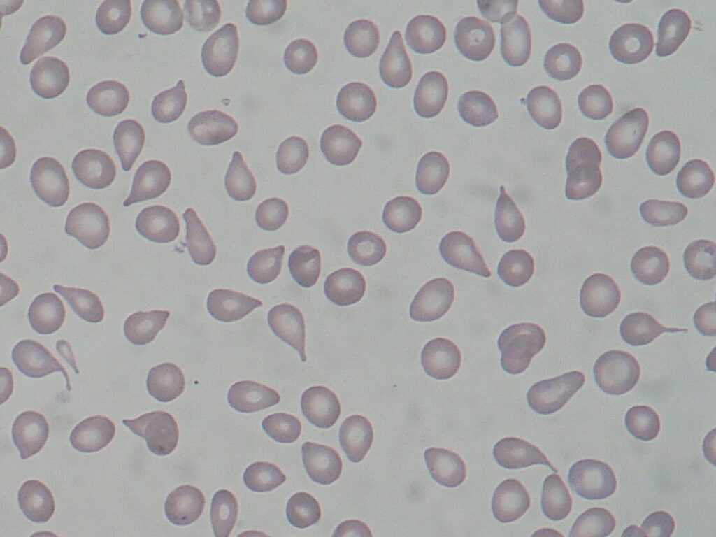 Comprendre le rôle des dacryocytes dans les maladies sanguines