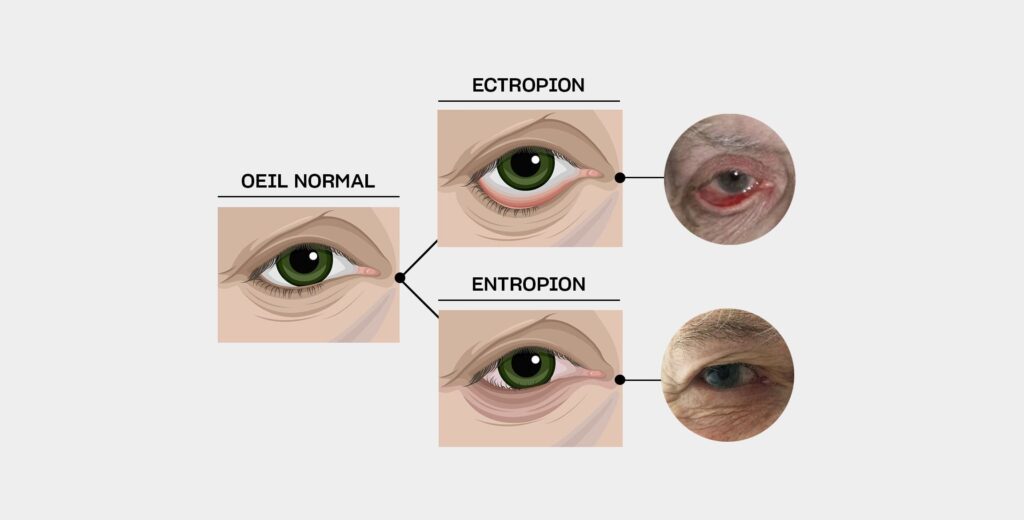 Ectropion de l’œil : causes, symptômes et traitements efficaces