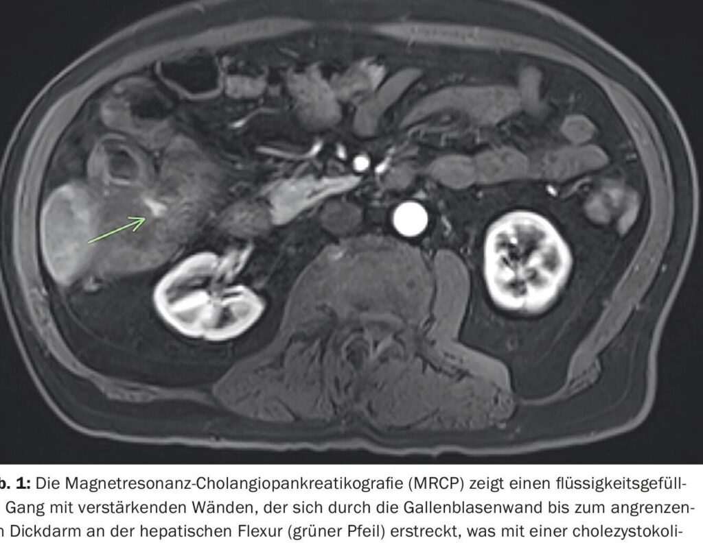 Ileus biliaire : comment le reconnaître et quelles sont les options de traitement ?