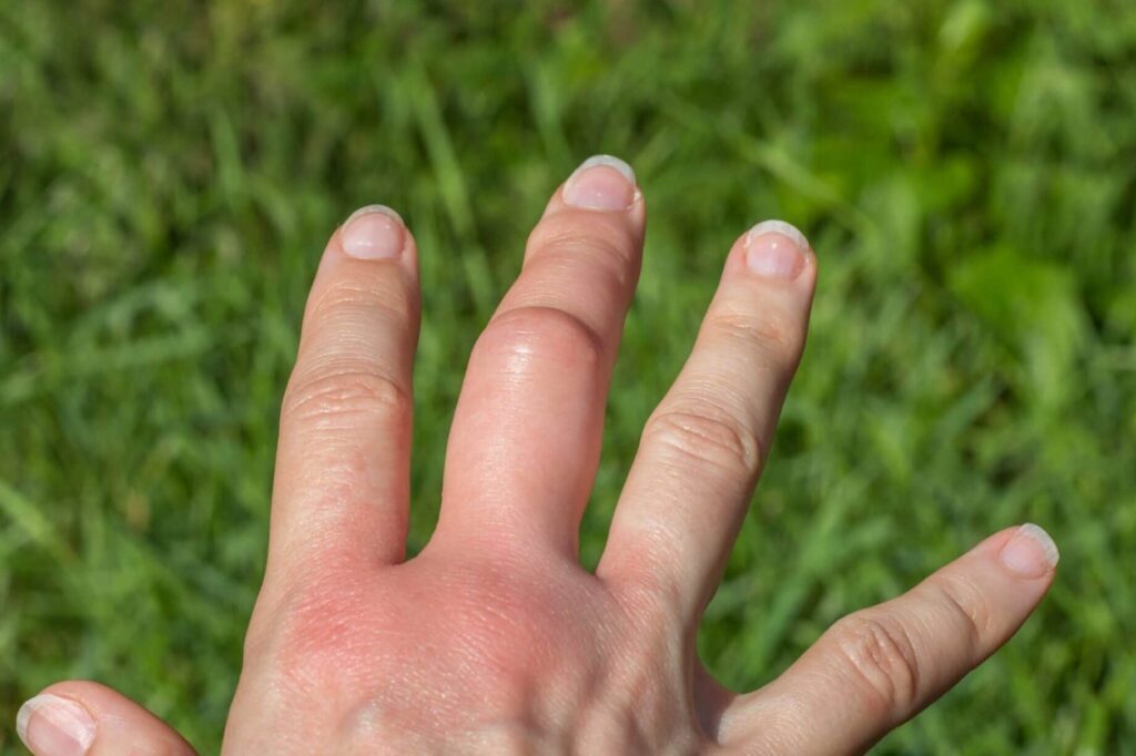 Kystes aux mains : comment les reconnaître et les traiter efficacement ?