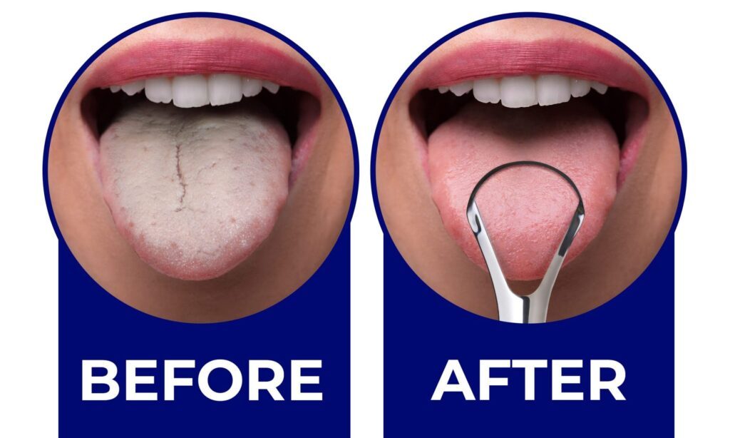 Pourquoi devriez-vous utiliser un gratte-langue pour une meilleure hygiène buccale ?
