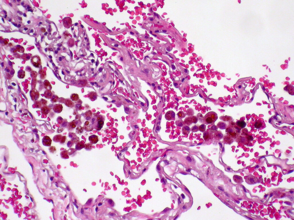 Comprendre l’hémosidérose pulmonaire : causes, symptômes et traitement