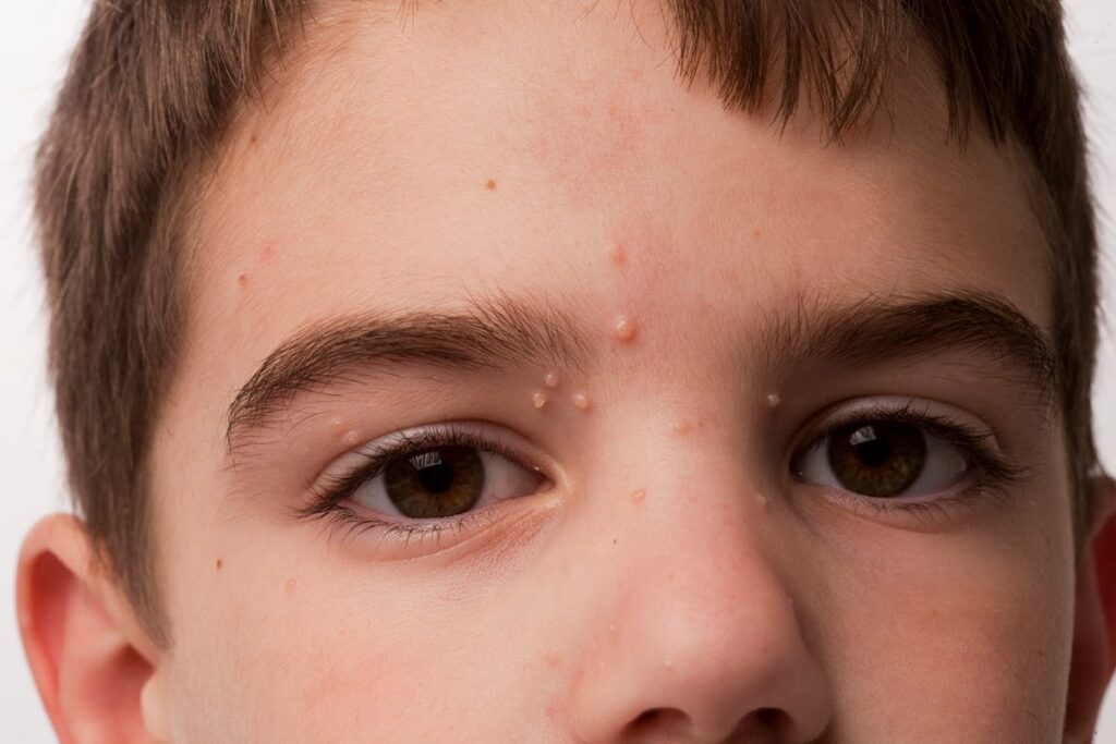 Exemple de lésions cutanées liées au molluscum contagiosum chez l'adulte