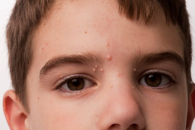 Exemple de lésions cutanées liées au molluscum contagiosum chez l'adulte