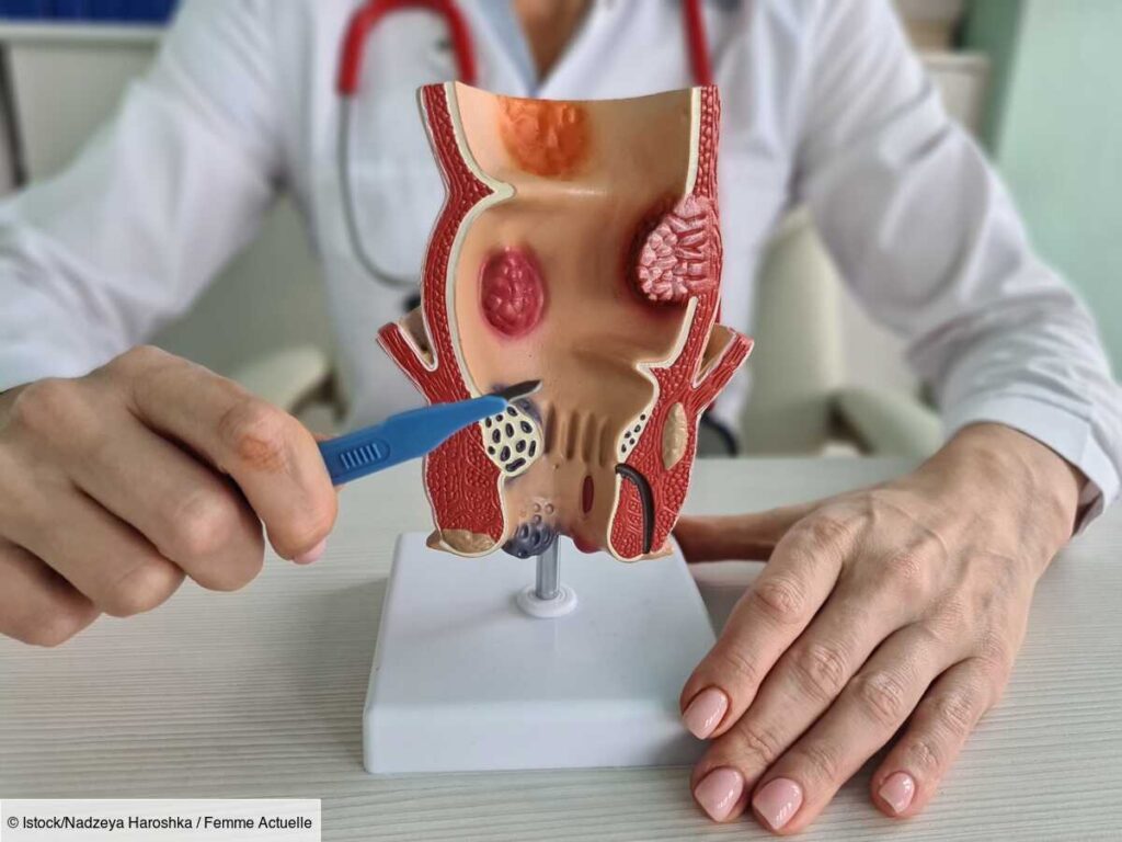 Choisir une pommade efficace sans ordonnance contre les hémorroïdes