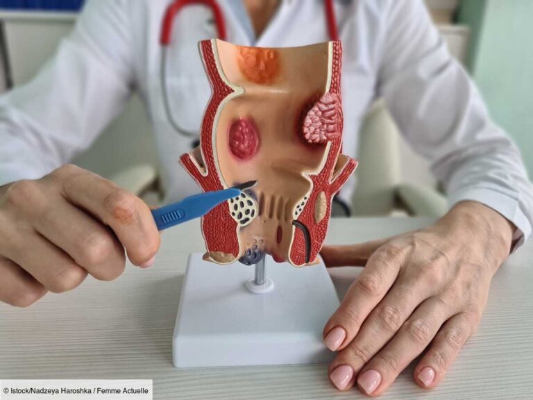 Choisir une pommade efficace sans ordonnance contre les hémorroïdes