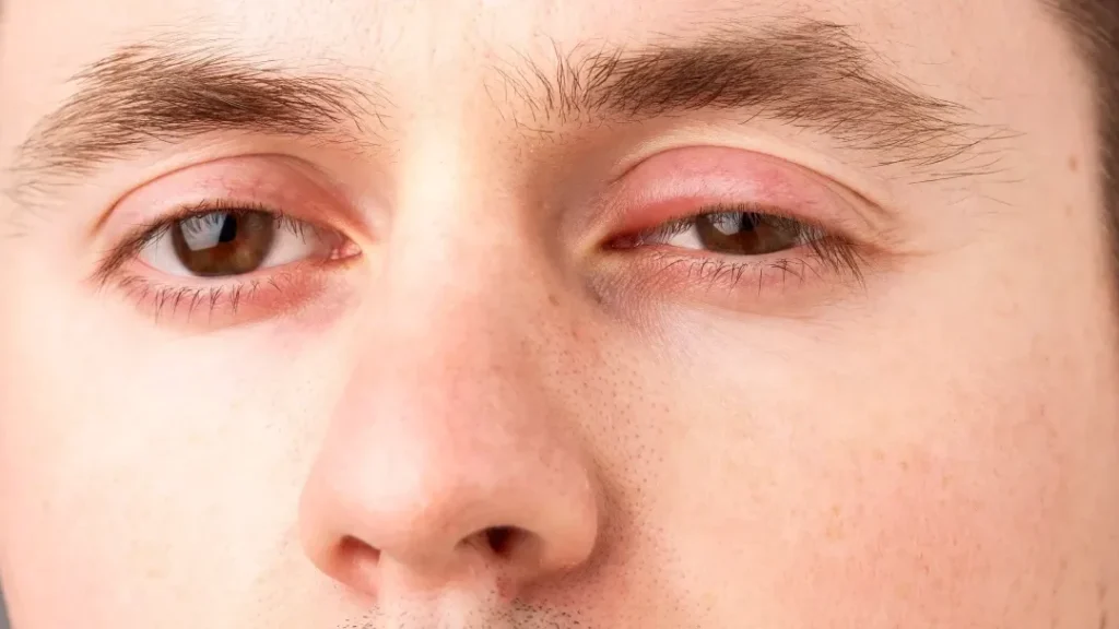 Pourquoi votre œil est-il gonflé au réveil ? Causes et solutions