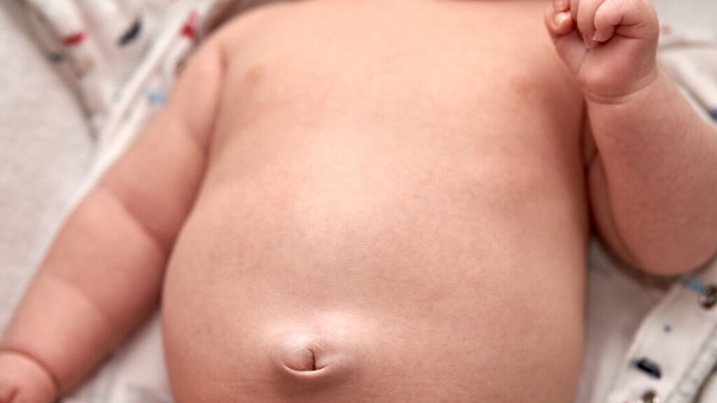 Comment reconnaître et traiter une hernie ombilicale chez l’enfant ?