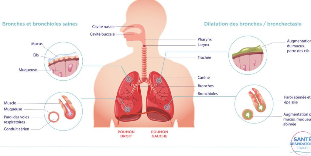 Comprendre la physiopathologie de la BPCO : une explication détaillée
