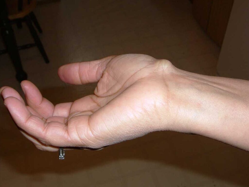 Ganglion au poignet : comment le reconnaître et quel traitement suivre ?