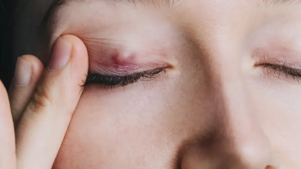 Quels sont les symptômes et traitements de la maladie des paupières ?