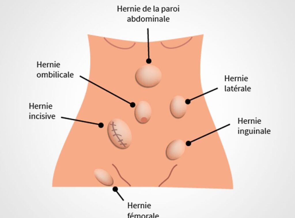 Hernie chez l&rsquo;enfant : symptômes, traitement et conseils de prévention