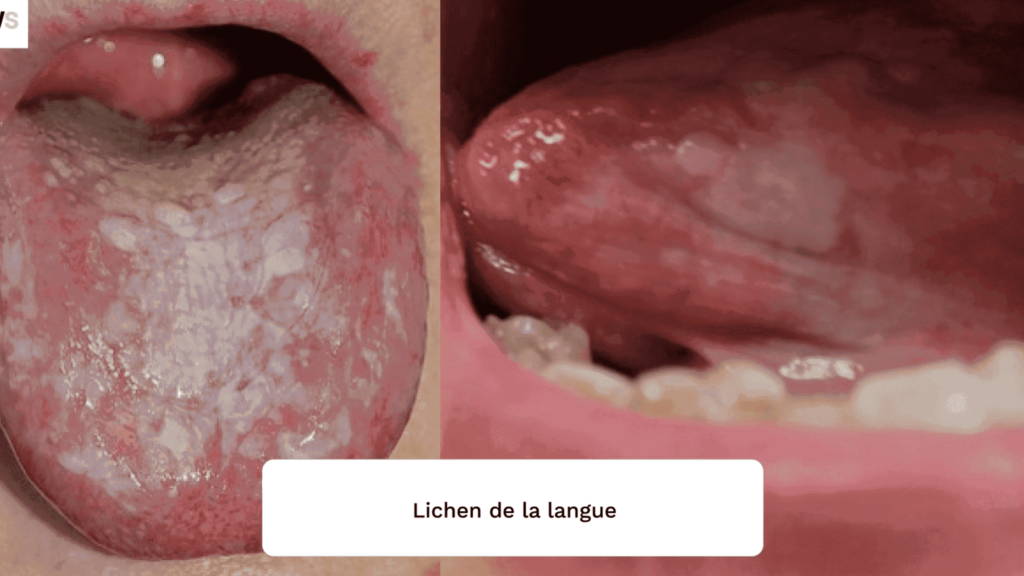 Lichen plan rouge : qu’est-ce que c’est et comment le traiter ?