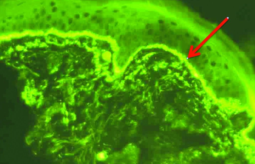 Néphrite lupique: comment reconnaître et traiter cette complication du lupus ?