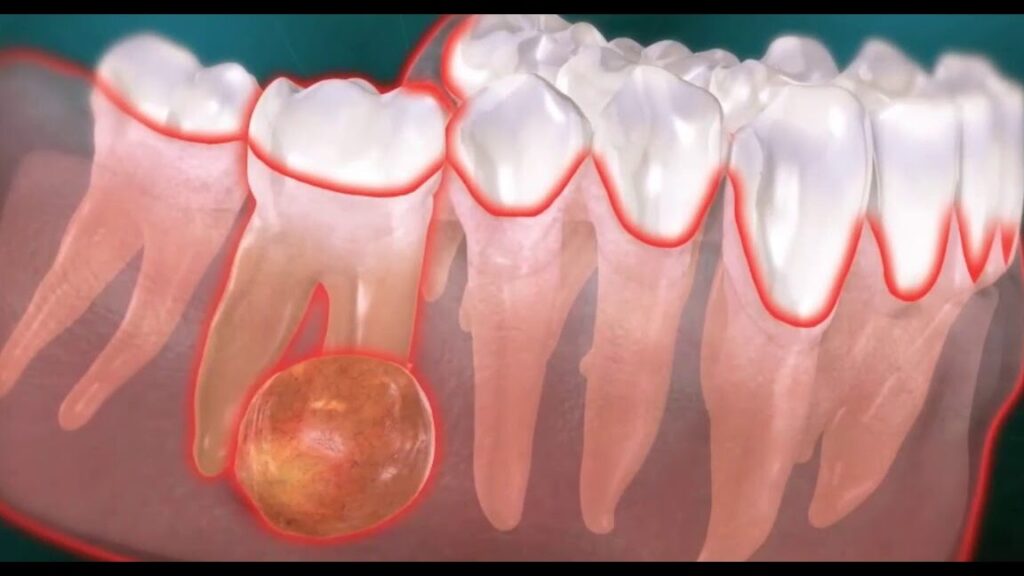 Comment reconnaître et traiter une dent infectée ?