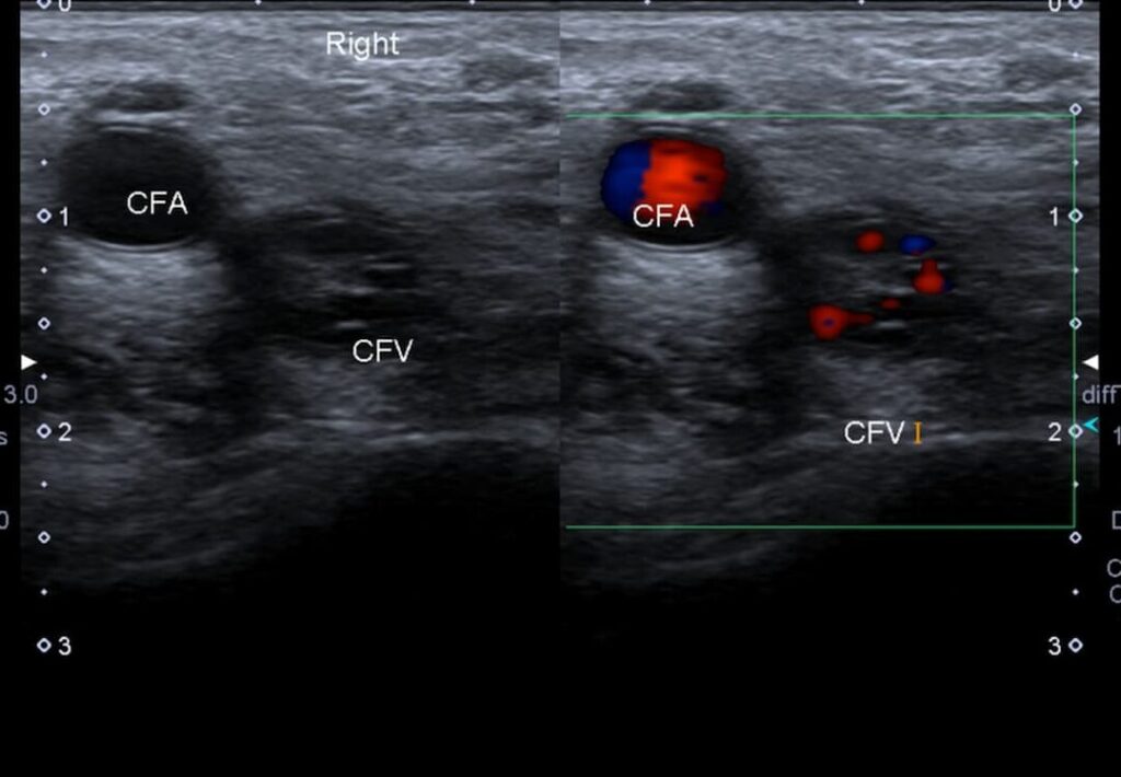Comprendre le score de Wells : comment évaluer le risque de thrombose veineuse ?