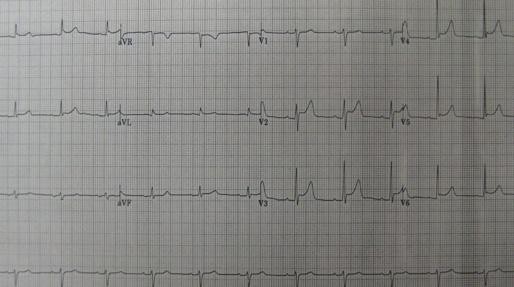 Comprendre les signes ECG caractéristiques de la péricardite