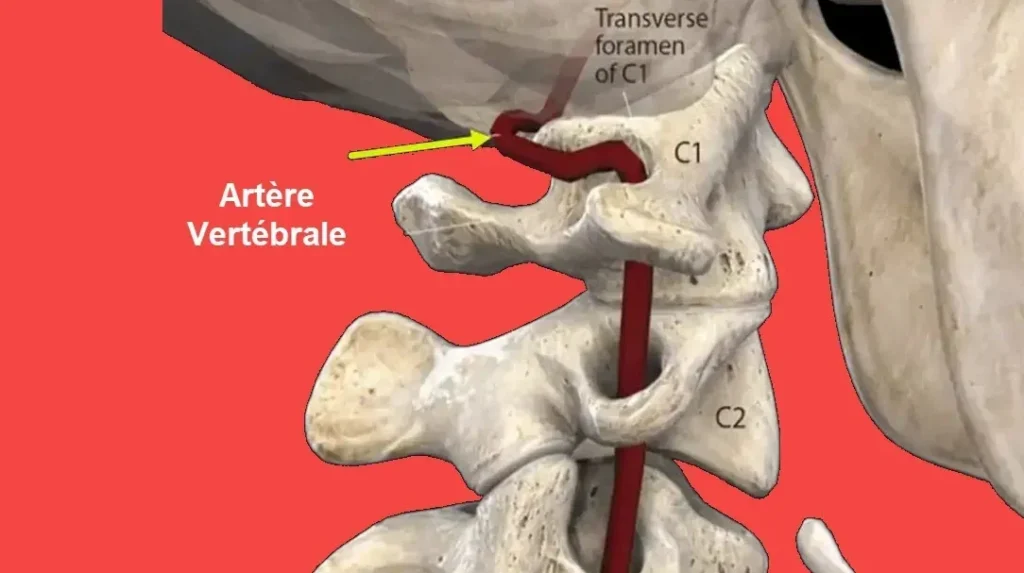 Instabilité cranio-cervicale : comment la reconnaître et la traiter ?
