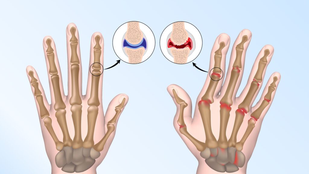 Nodules rhumatoïdes : tout comprendre sur ces manifestations de la polyarthrite rhumatoïde