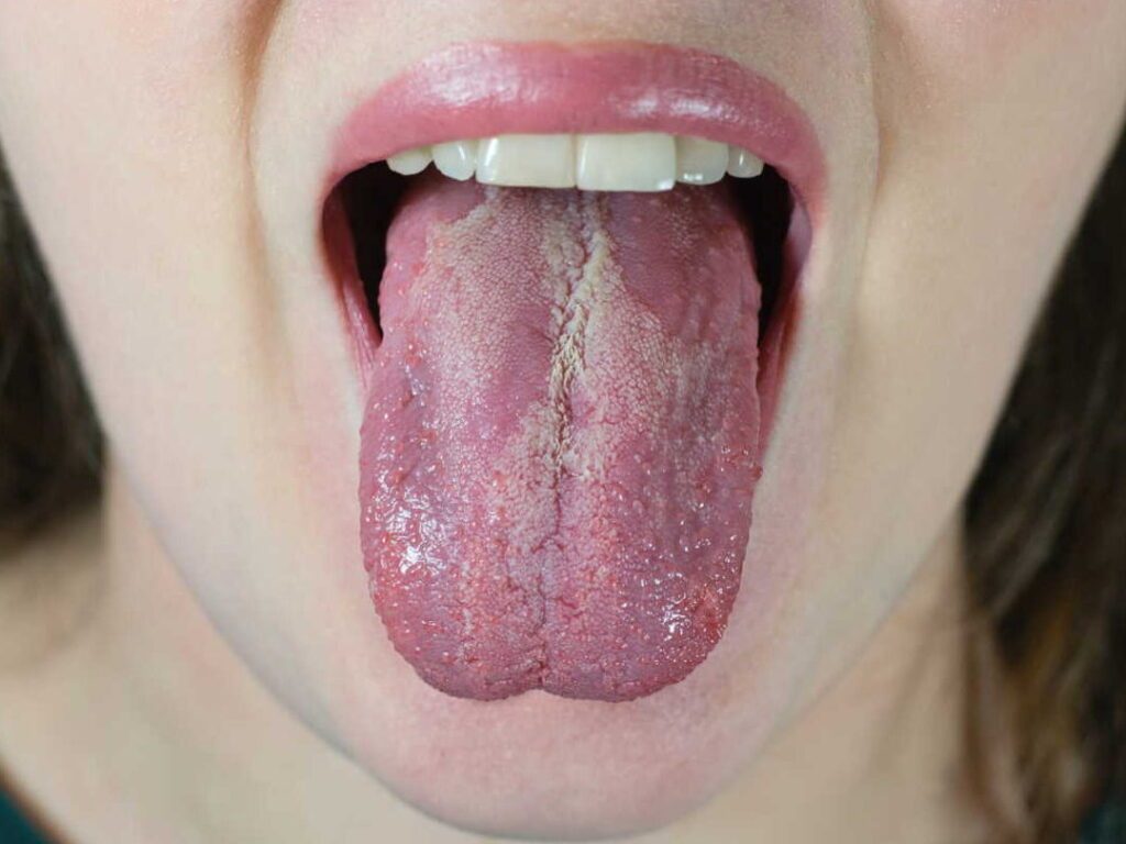 Brûlures dans la bouche : que faire pour apaiser la douleur rapidement ?