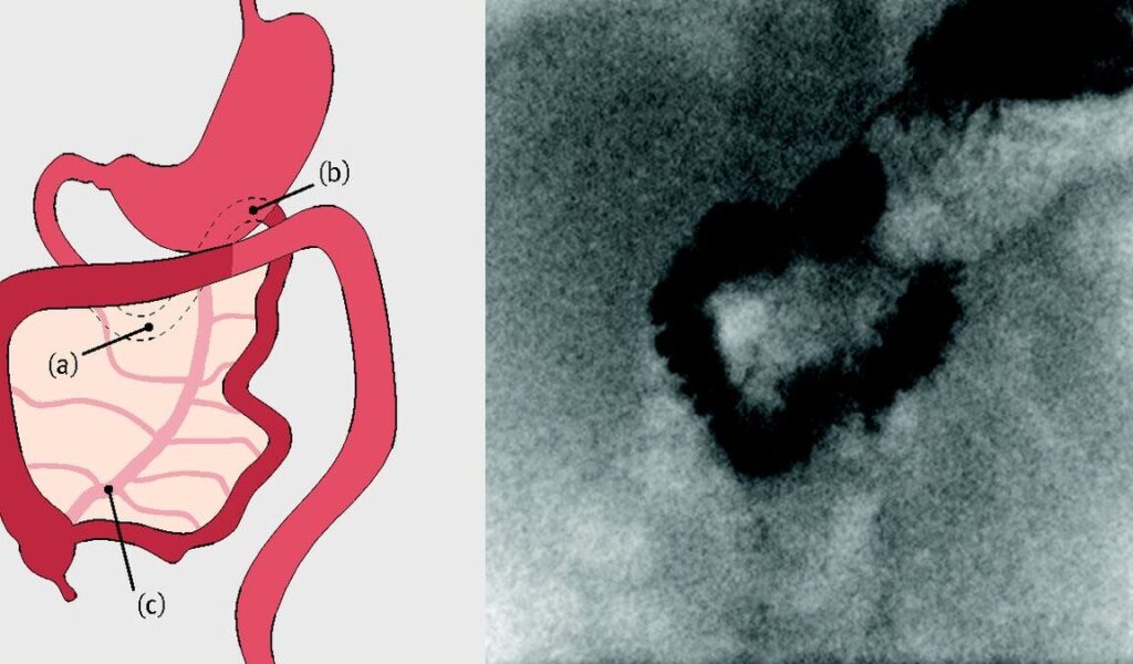 Comment reconnaître et traiter un volvulus chez le bébé ?