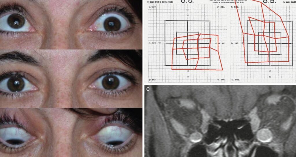 Comprendre l’ophtalmoplégie internucléaire : causes, symptômes et traitements