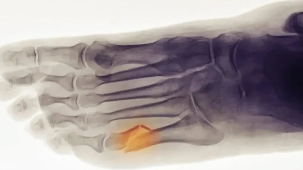 Fracture de Lisfranc : comment reconnaître les symptômes et quelles sont les options de traitement ?
