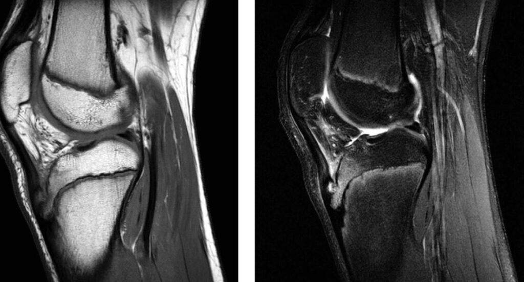 Maladie de Calvé-Legg-Perthes : comprendre et traiter cette pathologie infantile