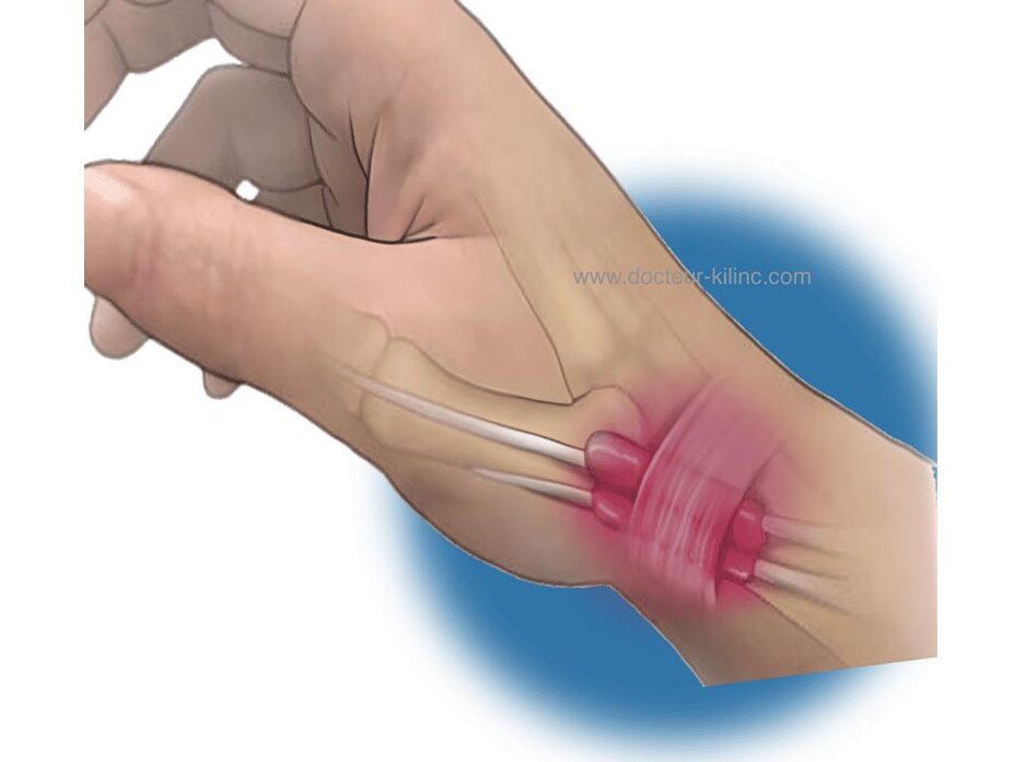 Douleur au poignet : tout savoir sur la maladie de Quervain