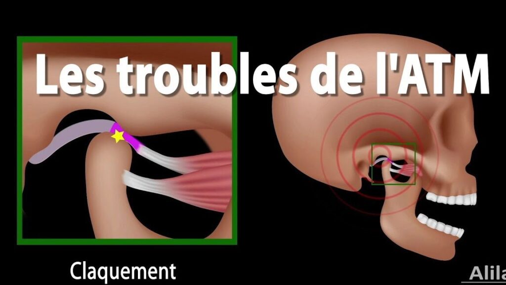 Douleurs à l’articulation temporo-mandibulaire : comprendre et traiter efficacement