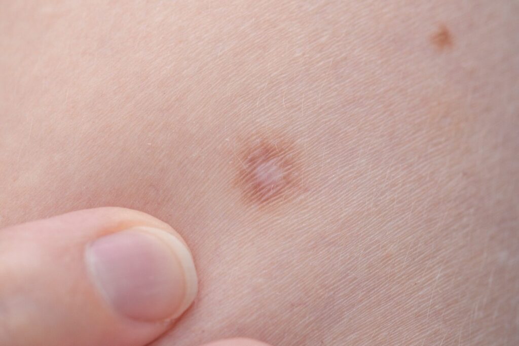 Fibrome sur la cuisse : symptômes, causes et traitements efficaces