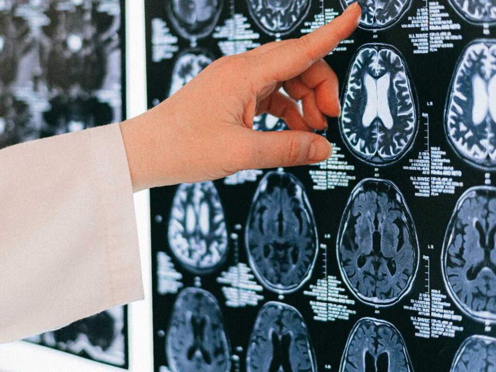 Hématome cérébelleux : signes, causes et traitements essentiels