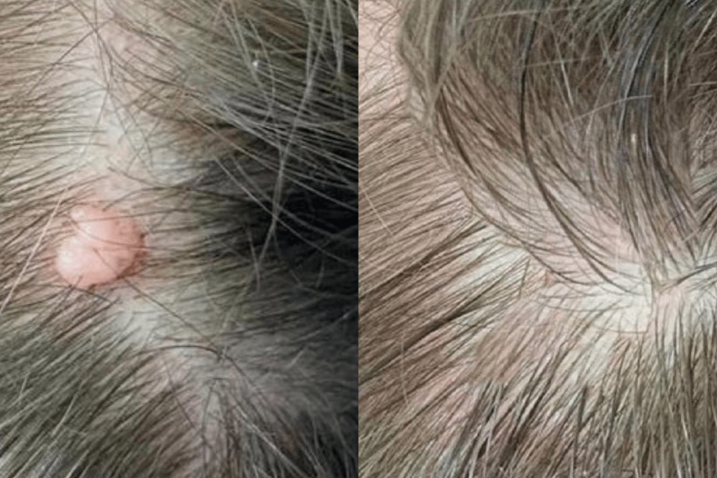 Tache noire sur le cuir chevelu : causes et solutions pour y remédier