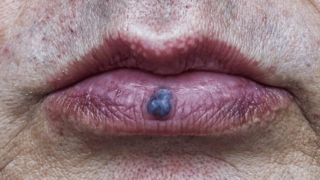 Bouton noir sur la lèvre : que signifie-t-il et comment réagir ?