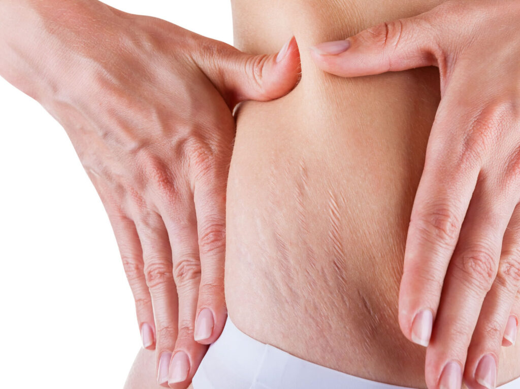 Comprendre et gérer le syndrome de Cushing : quels traitements disponibles ?
