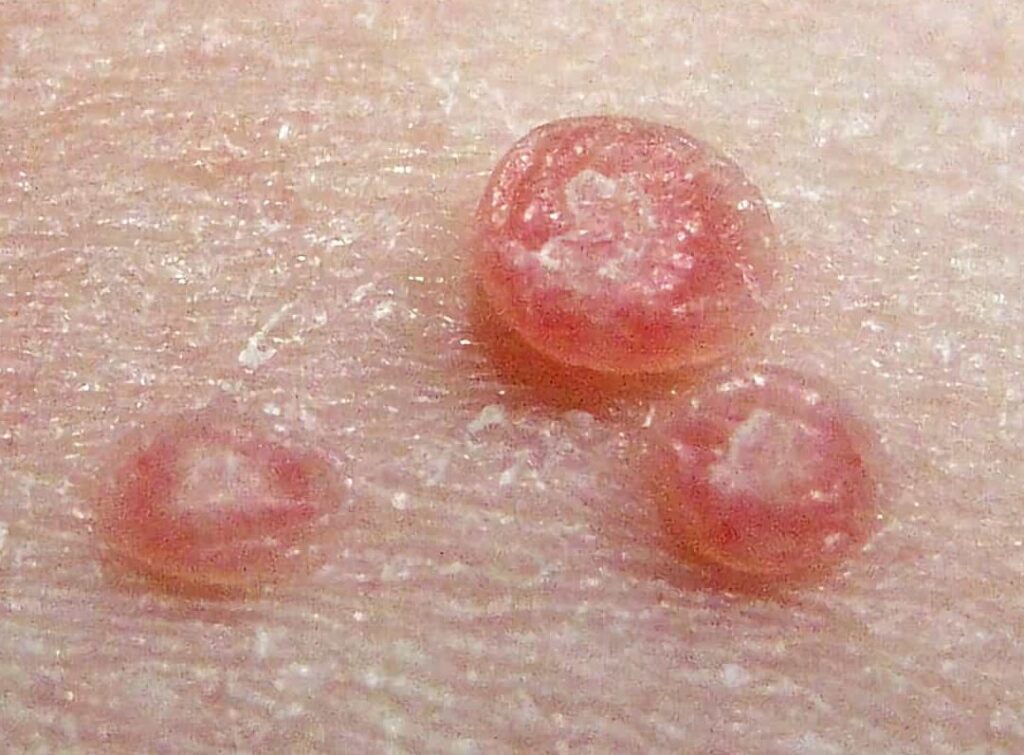 Comprendre et traiter le molluscum contagiosum sur le pénis