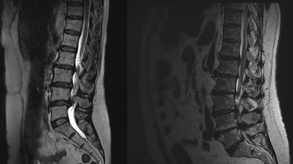Hernie discale et syndrome de la queue de cheval: comprendre les risques et les traitements