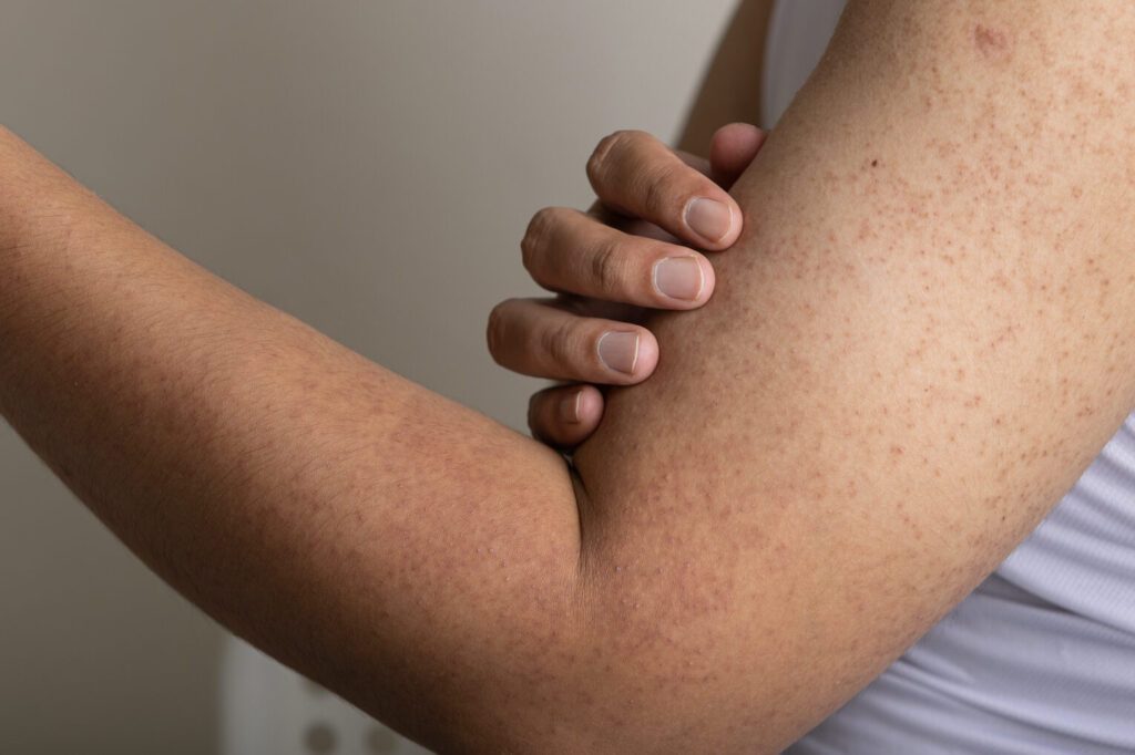 Comment traiter la kératose pilaire avec les meilleures crèmes disponibles ?