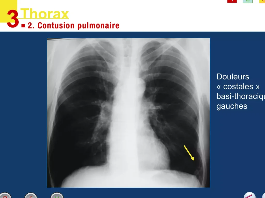 Cul de sac pleural : comprendre cette particularité anatomique et ses implications médicales