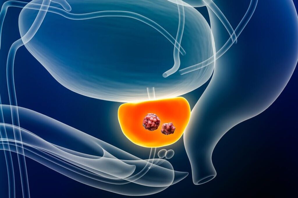 Comprendre la bronchectasie à l’image : décryptage d’une radio pulmonaire