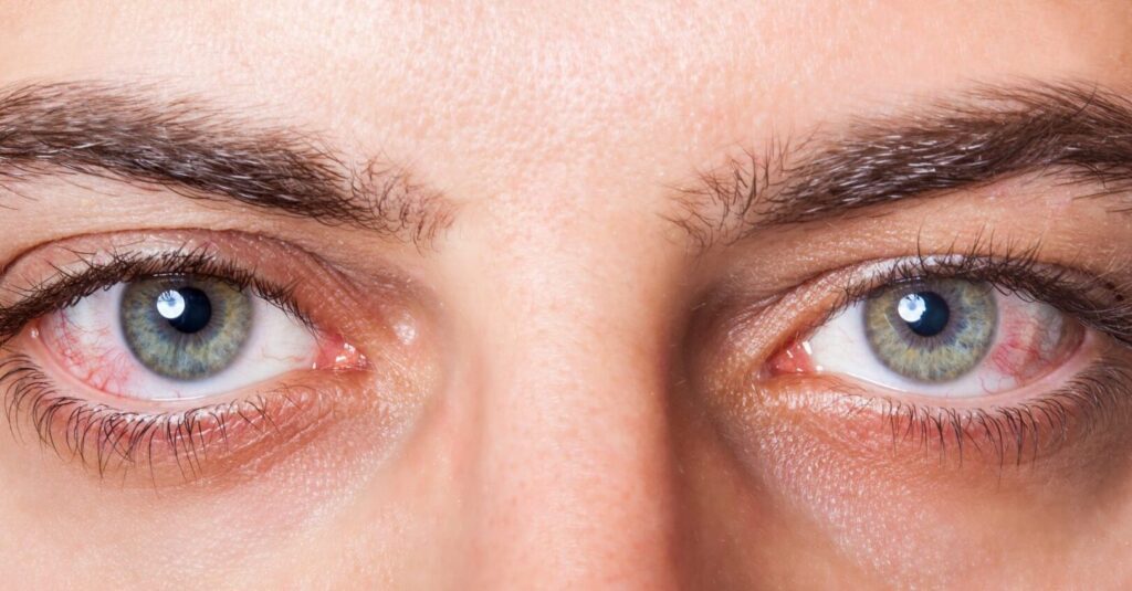 Comprendre le glaucome à angle fermé : causes, symptômes et traitements