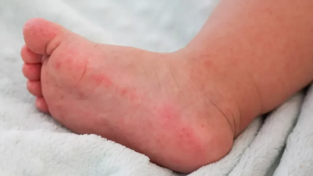 Erythermalgie : quels traitements naturels pour apaiser les douleurs ?