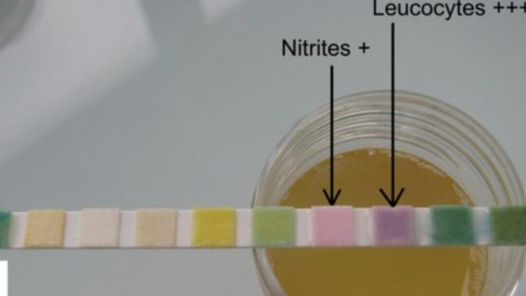 Nitrites dans l’urine : comment les détecter avec une bandelette réactive ?